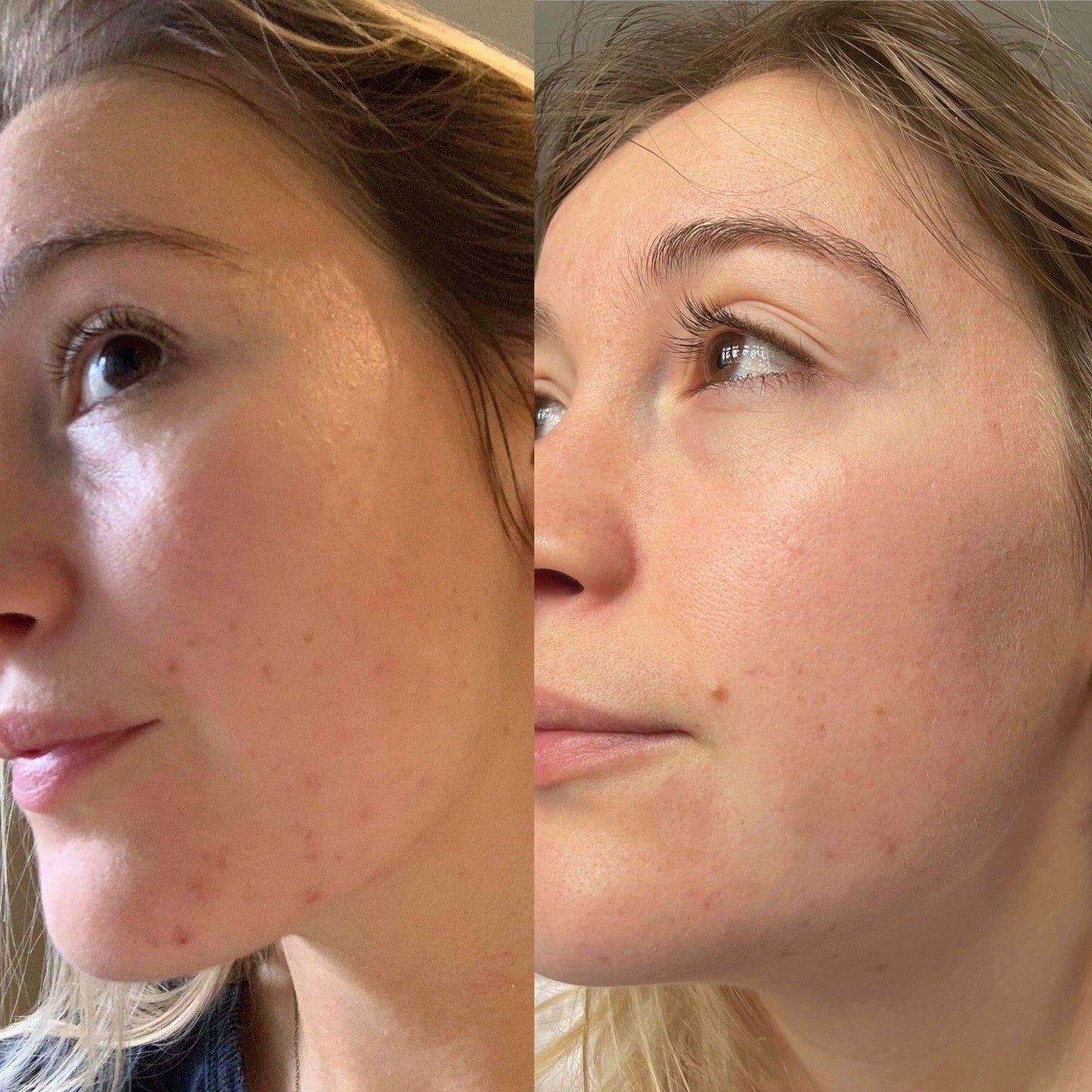 Argan Acne Rehab Serum 30ml | Plant-Based Formula For Acne-Prone Skin