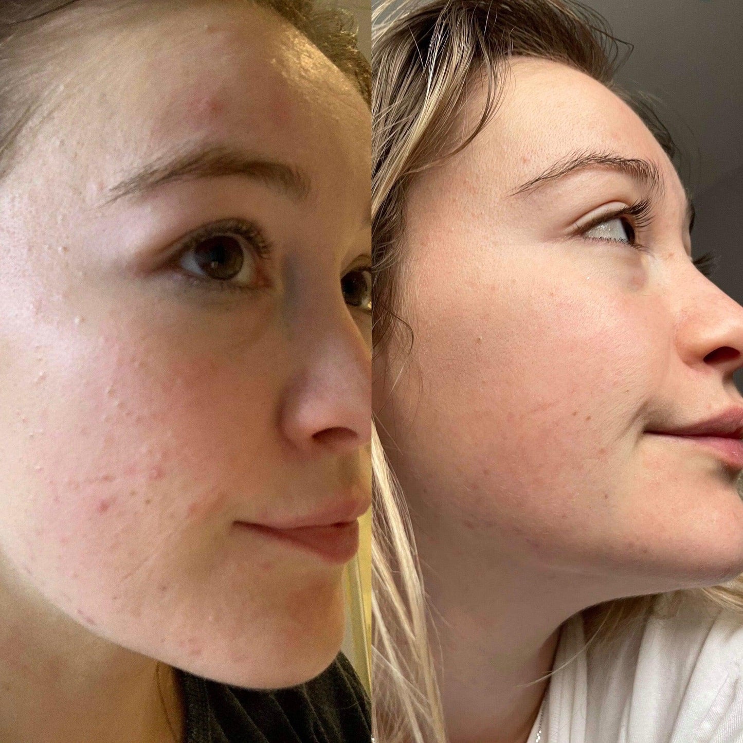 Argan Acne Rehab Serum 30ml | Plant-Based Formula For Acne-Prone Skin