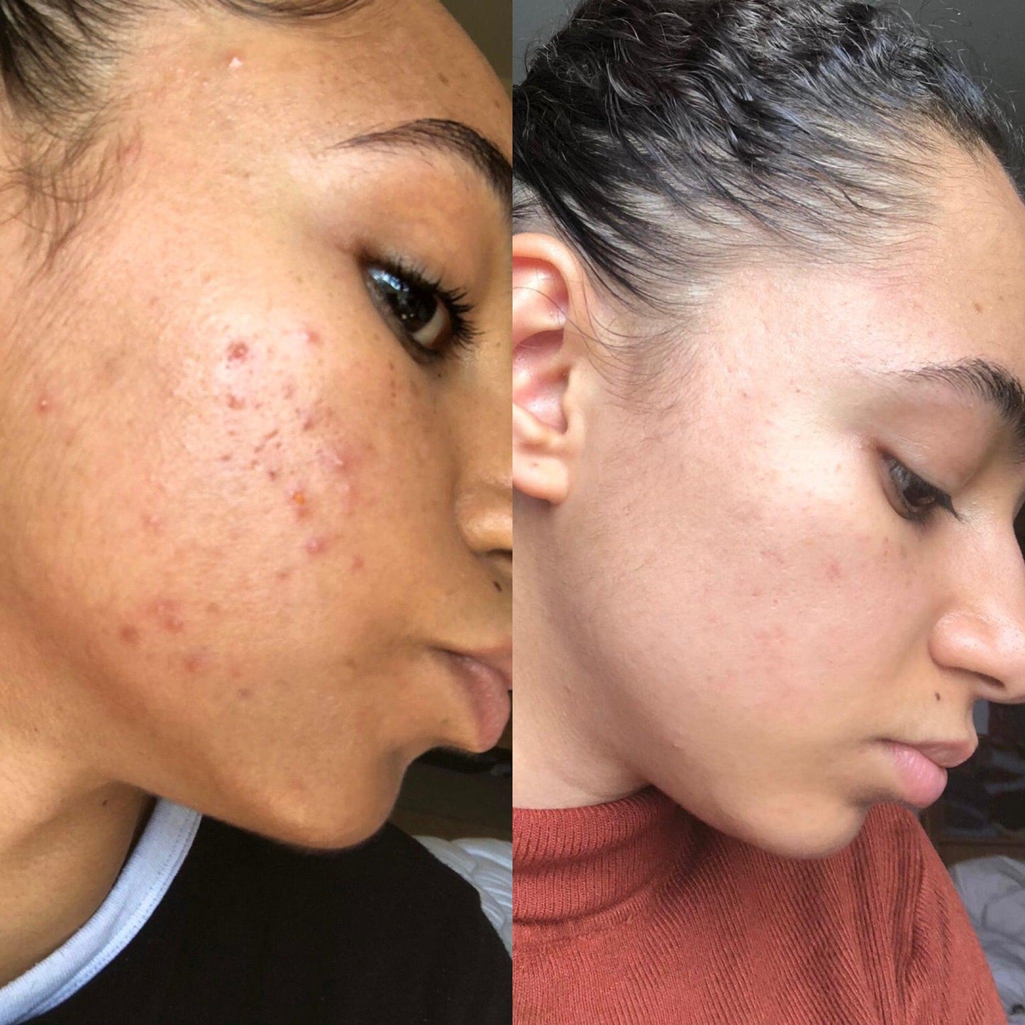 Argan Acne Rehab Serum 30ml | Plant-Based Formula For Acne-Prone Skin