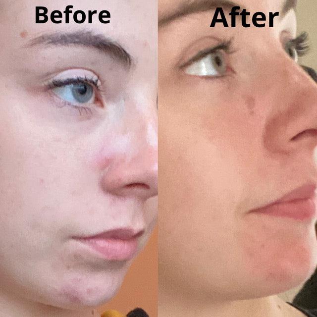 Argan Acne Rehab Serum 30ml | Plant-Based Formula For Acne-Prone Skin