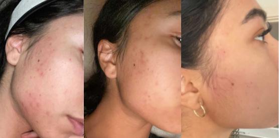 Argan Acne Rehab Serum 30ml | Plant-Based Formula For Acne-Prone Skin