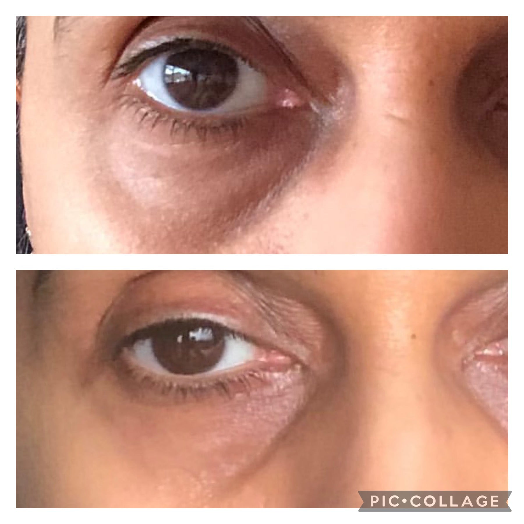 Close-up of a person's eye before and after an intervention, with 'PIC-COLLAGE' watermark.
