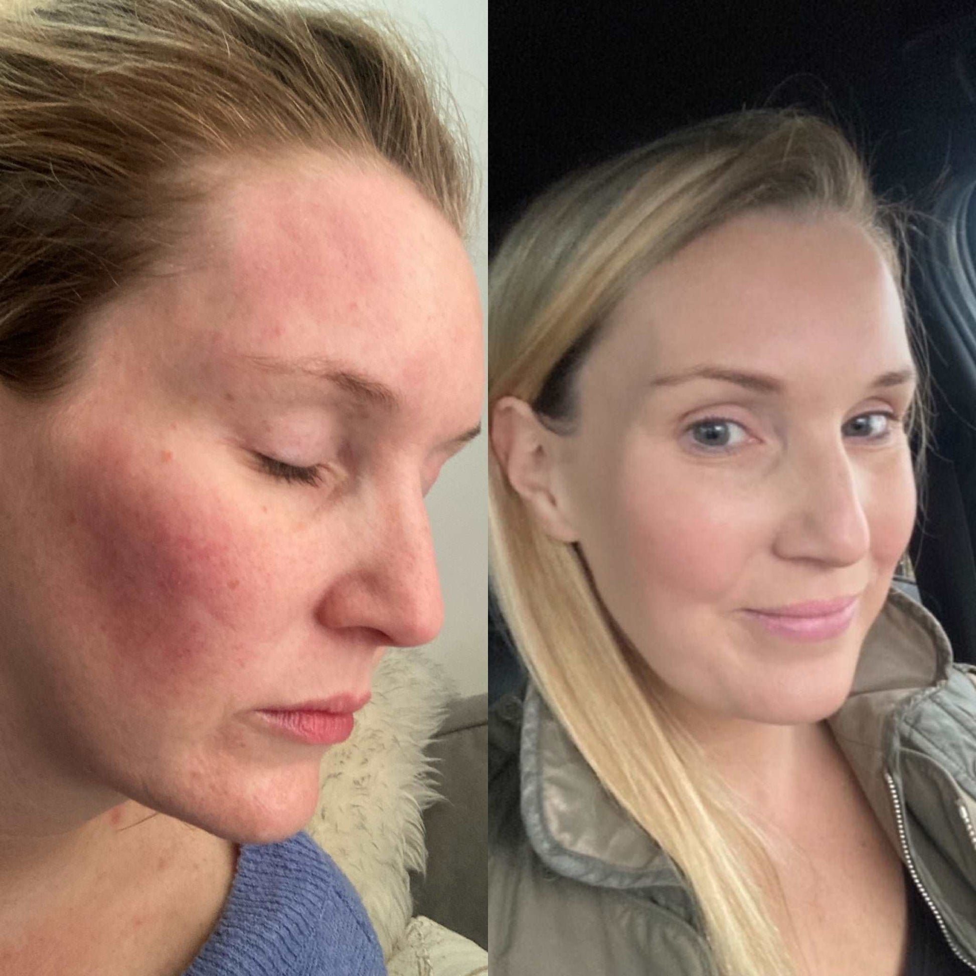 Before and after comparison of a woman's face with visible skin concerns.